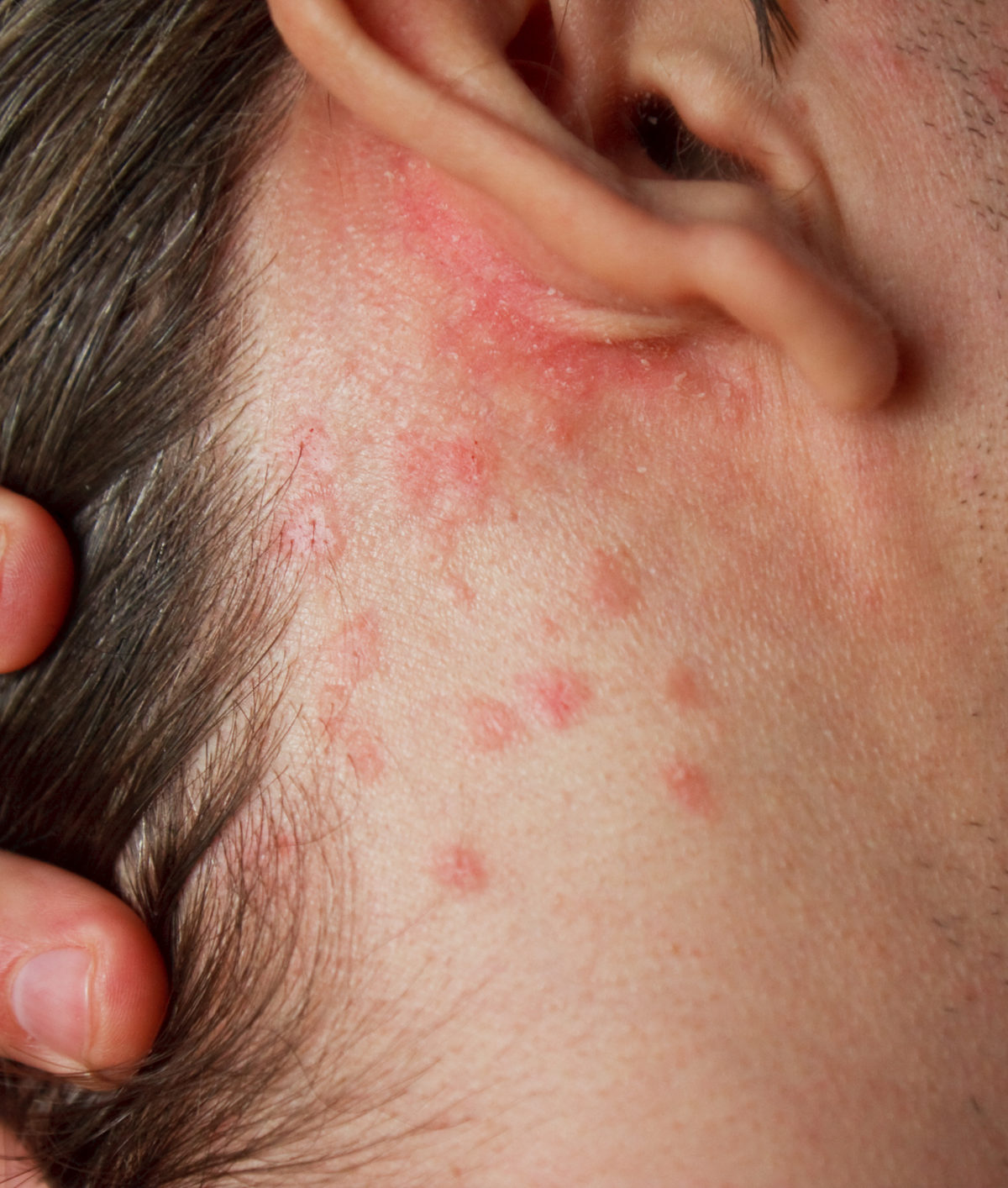Psoriasis